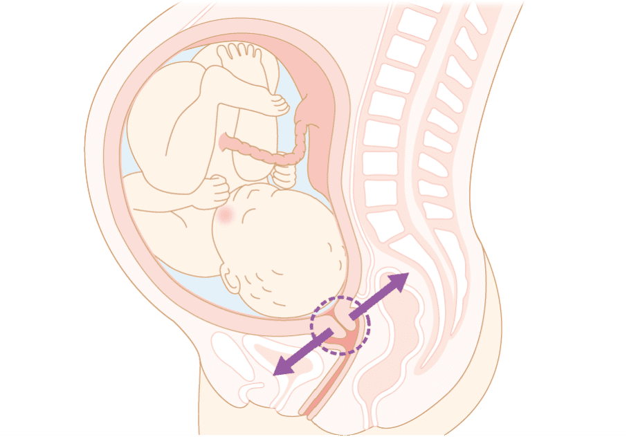妊娠37週以降の子宮頸管熟化不全の妊婦